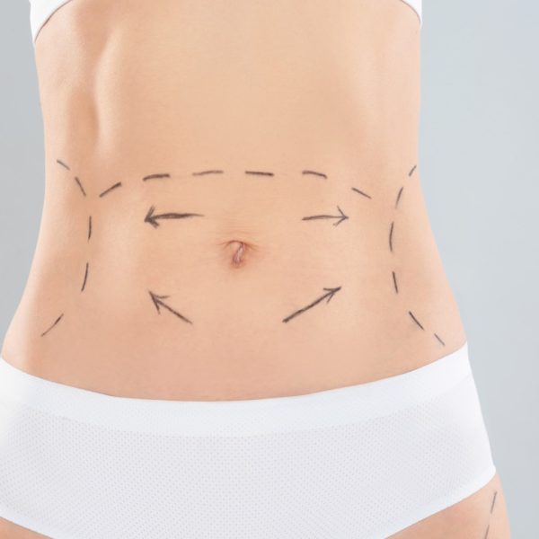 Woman with marks on body for cosmetic surgery operation against grey background, closeup